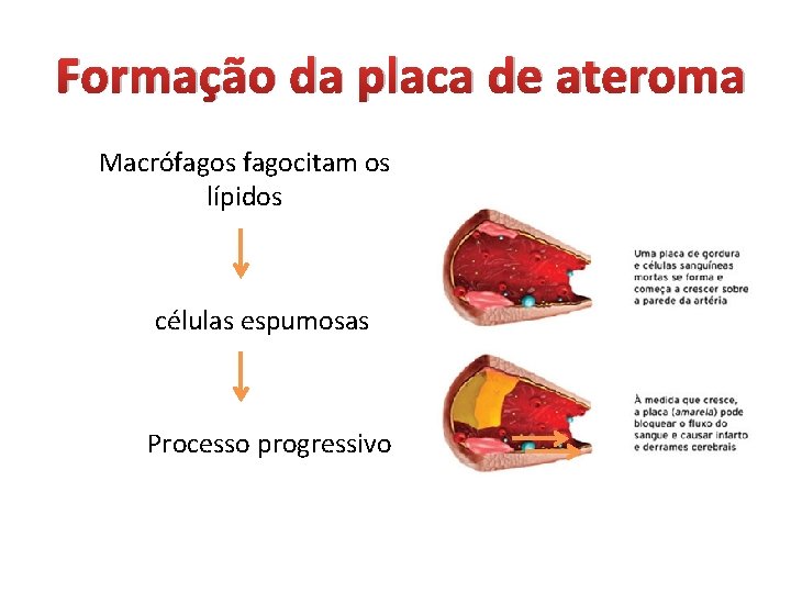 Formação da placa de ateroma Macrófagos fagocitam os lípidos células espumosas Processo progressivo 