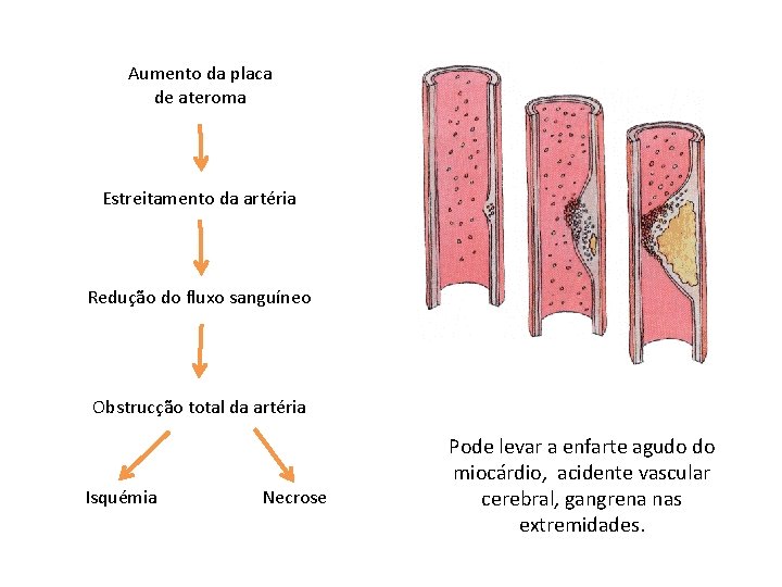 Aumento da placa de ateroma Estreitamento da artéria Redução do fluxo sanguíneo Obstrucção total