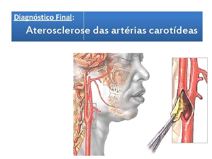 Diagnóstico Final: Aterosclerose das artérias carotídeas 