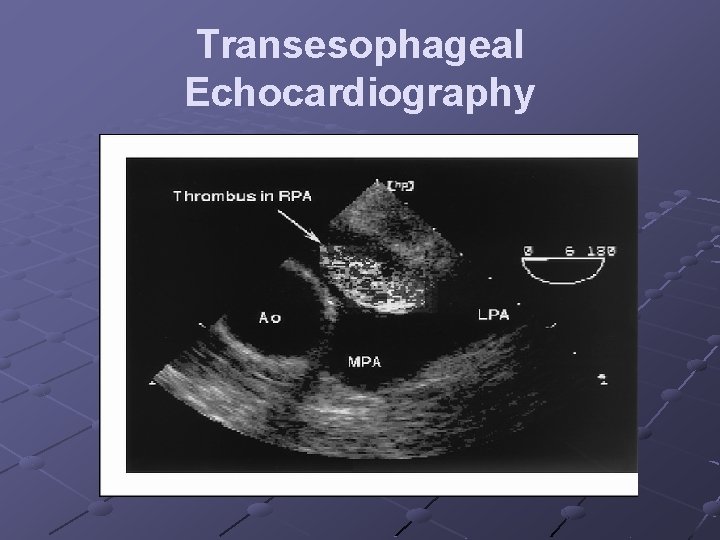 Transesophageal Echocardiography 