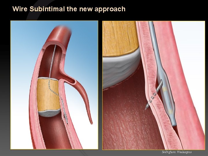 Wire Subintimal the new approach 