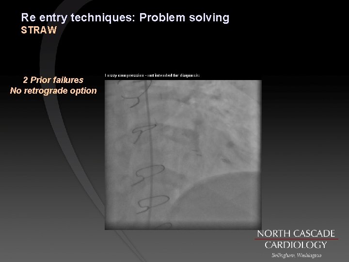 Re entry techniques: Problem solving STRAW 2 Prior failures No retrograde option 