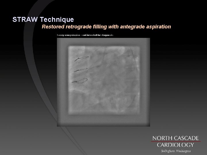 STRAW Technique Restored retrograde filling with antegrade aspiration 