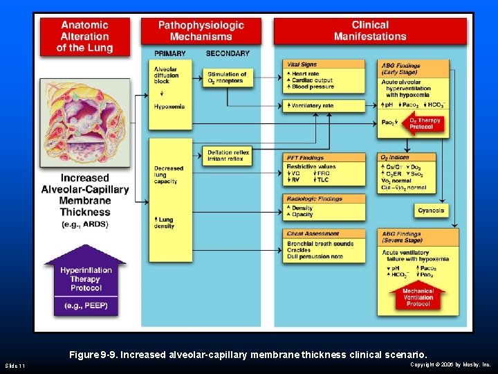 Figure 9 -9. Increased alveolar-capillary membrane thickness clinical scenario. Slide 11 Copyright © 2006