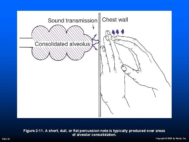 Figure 2 -11. A short, dull, or flat percussion note is typically produced over