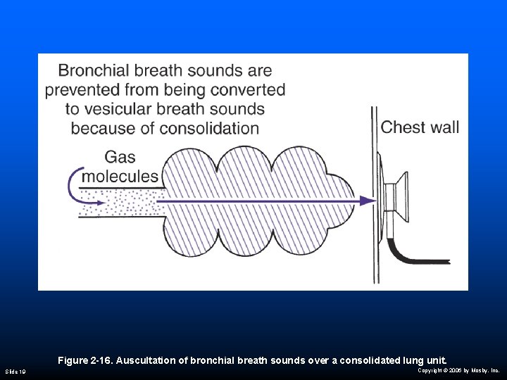 Figure 2 -16. Auscultation of bronchial breath sounds over a consolidated lung unit. Slide