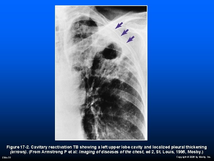 Figure 17 -2. Cavitary reactivation TB showing a left upper lobe cavity and localized