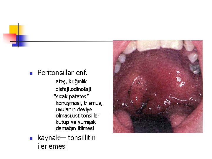 n Peritonsillar enf. ateş, kırğınlık disfaji, odinofaji “sıcak patates” konuşması, trismus, uvulanın deviye olması,