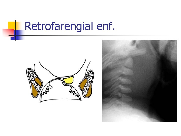 Retrofarengial enf. 