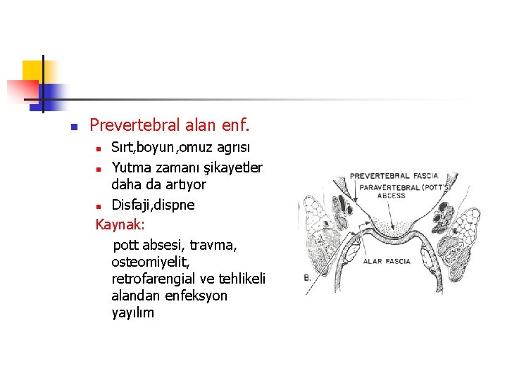 n Prevertebral alan enf. Sırt, boyun, omuz agrısı n Yutma zamanı şikayetler daha da