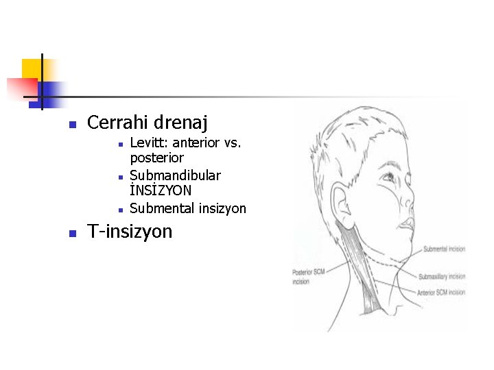 n Cerrahi drenaj n n Levitt: anterior vs. posterior Submandibular İNSİZYON Submental insizyon T-insizyon