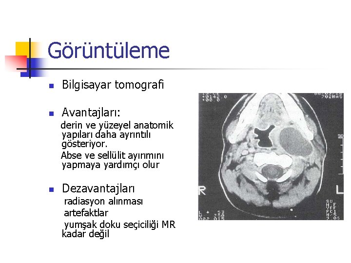 Görüntüleme n Bilgisayar tomografi n Avantajları: derin ve yüzeyel anatomik yapıları daha ayrıntılı gösteriyor.