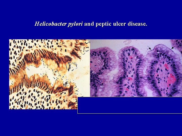 Helicobacter pylori and peptic ulcer disease. 