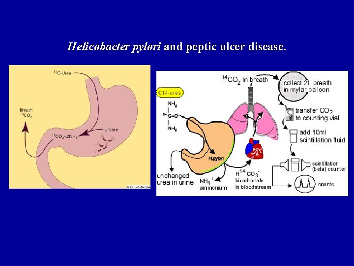 Helicobacter pylori and peptic ulcer disease. 