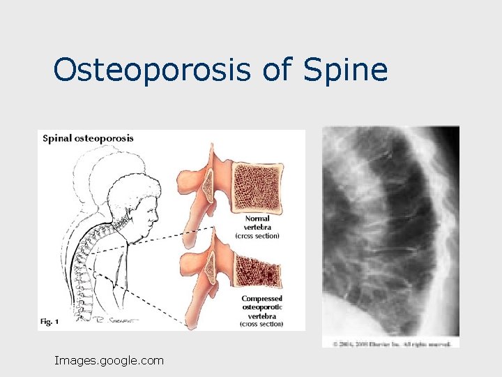 Osteoporosis of Spine Images. google. com 