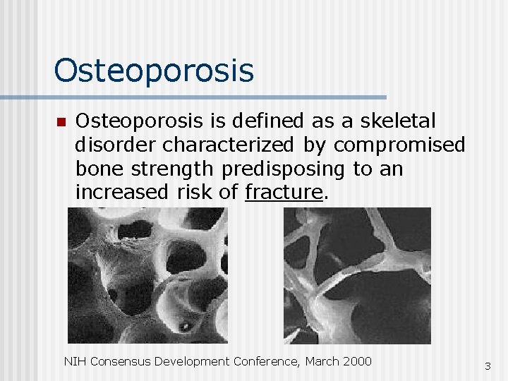 Osteoporosis n Osteoporosis is defined as a skeletal disorder characterized by compromised bone strength