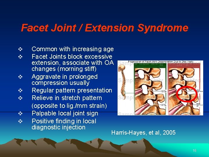 Facet Joint / Extension Syndrome v v v v Common with increasing age Facet