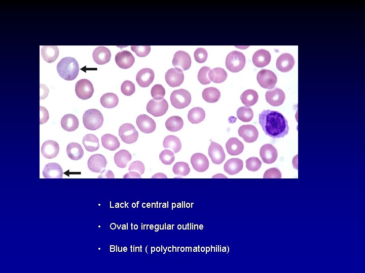  • Lack of central pallor • Oval to irregular outline • Blue tint