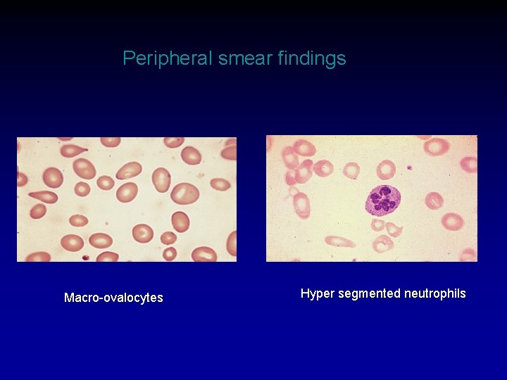 Peripheral smear findings Macro-ovalocytes Hyper segmented neutrophils 