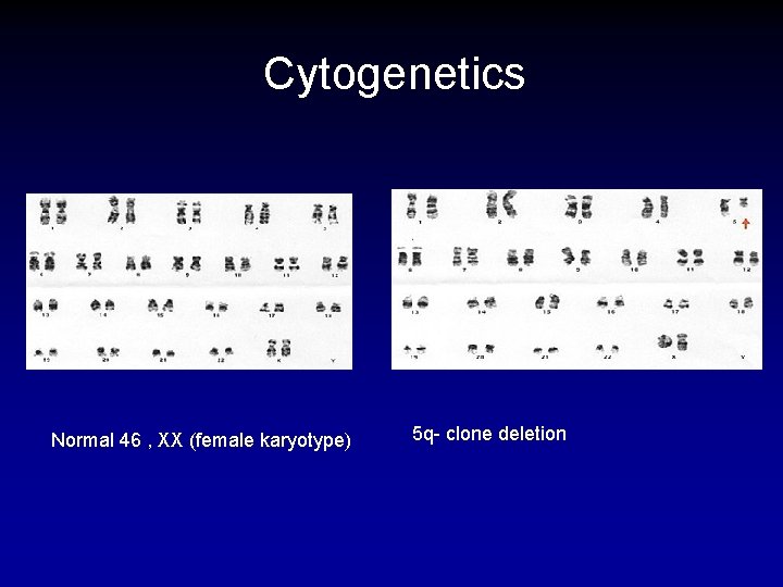 Cytogenetics Normal 46 , XX (female karyotype) 5 q- clone deletion 