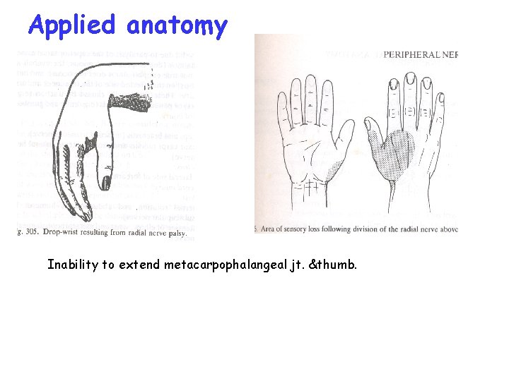 Applied anatomy Inability to extend metacarpophalangeal jt. &thumb. 