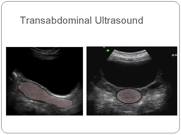 Transabdominal Ultrasound 