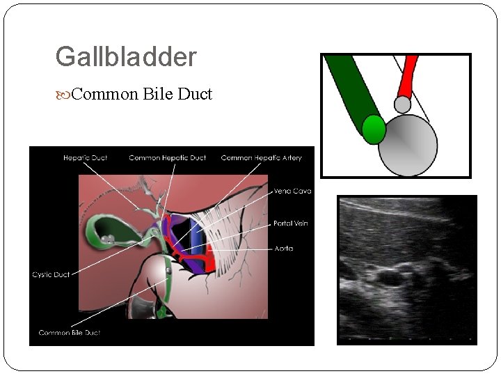 Gallbladder Common Bile Duct 