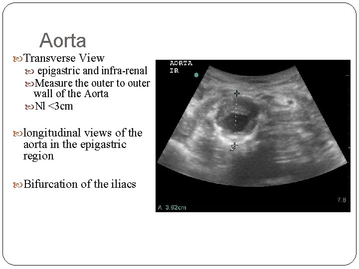 Aorta Transverse View epigastric and infra-renal Measure the outer to outer wall of the