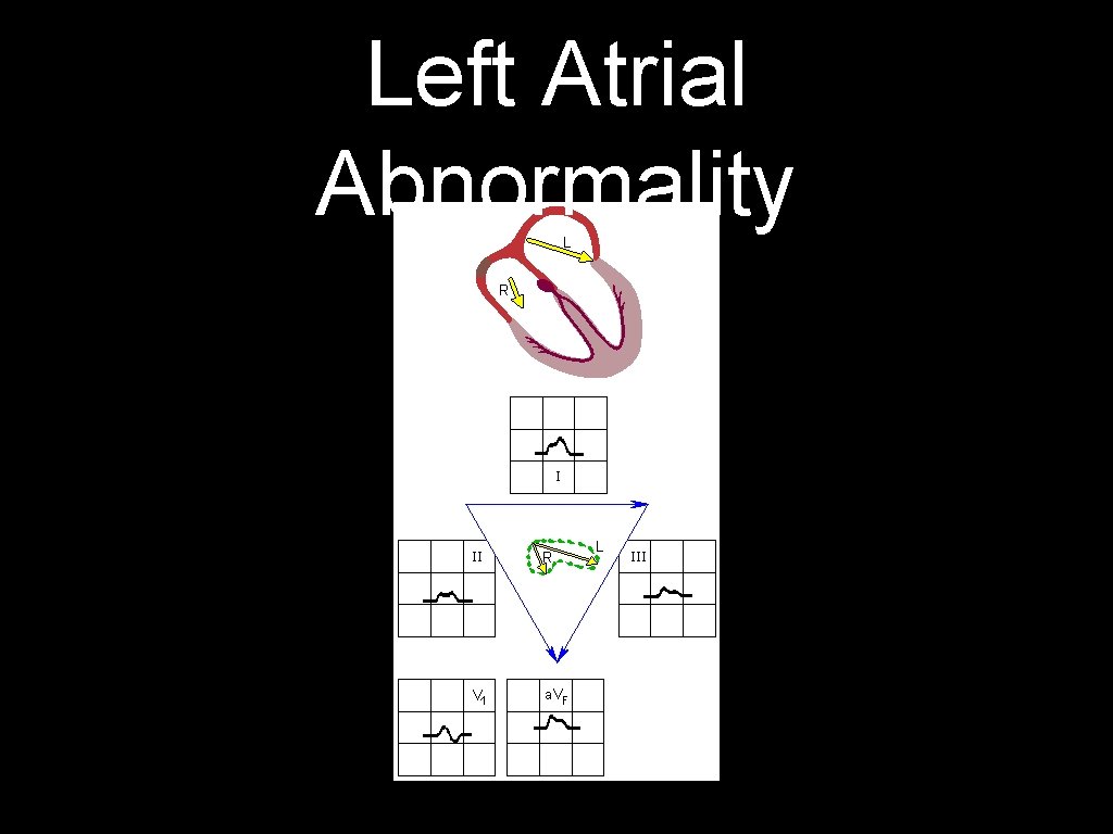 Left Atrial Abnormality 