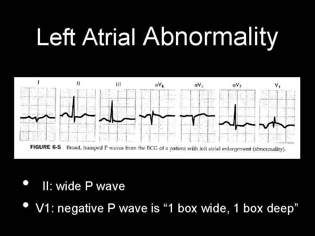 Left Atrial Abnormality • • II: wide P wave V 1: negative P wave