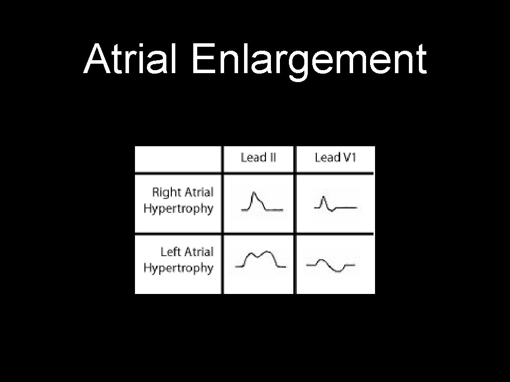 Atrial Enlargement 