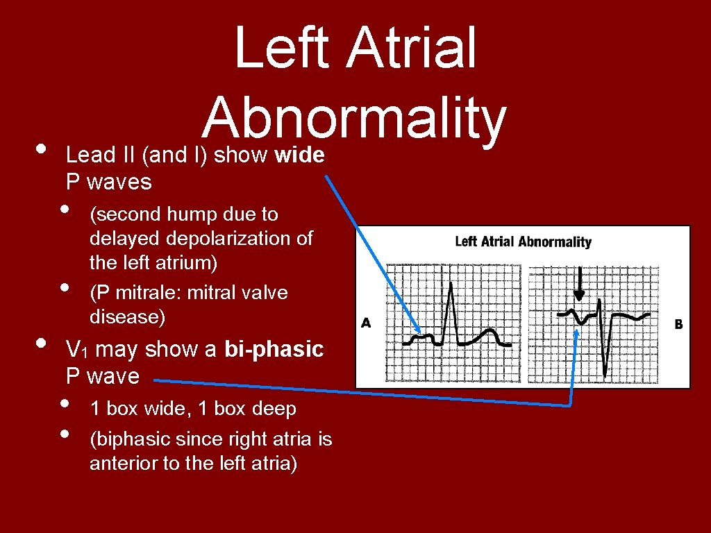  • Left Atrial Abnormality Lead II (and I) show wide P waves •