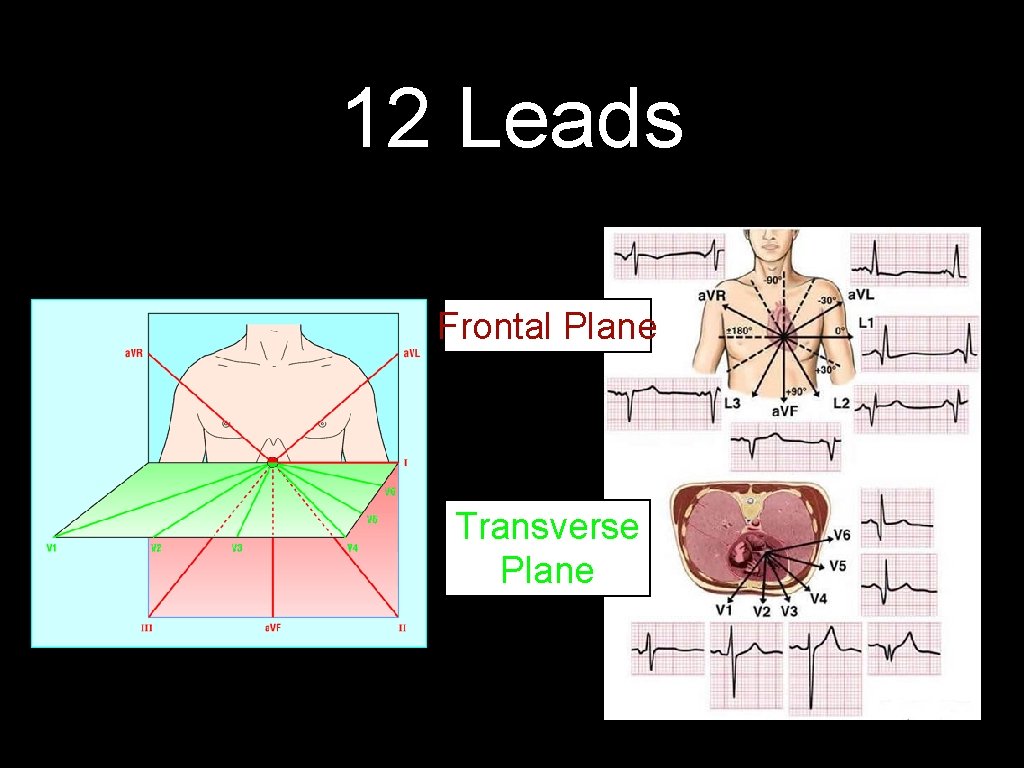 12 Leads Frontal Plane Transverse Plane 