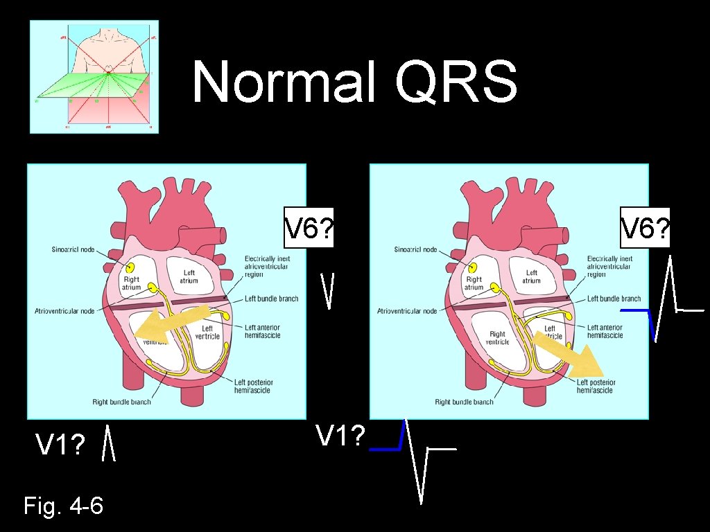 Normal QRS V 6? V 1? Fig. 4 -6 V 1? V 6? 