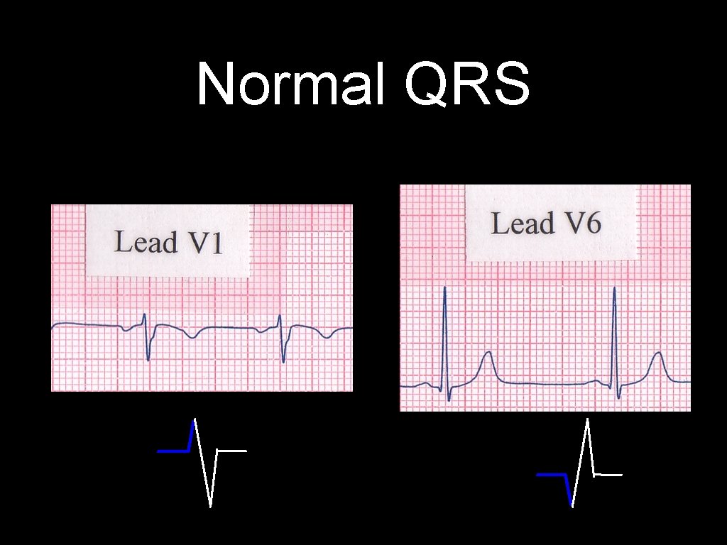 Normal QRS 