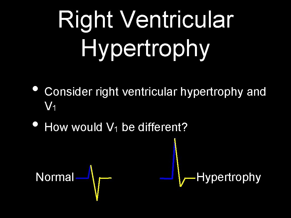 Right Ventricular Hypertrophy • Consider right ventricular hypertrophy and V 1 • How would