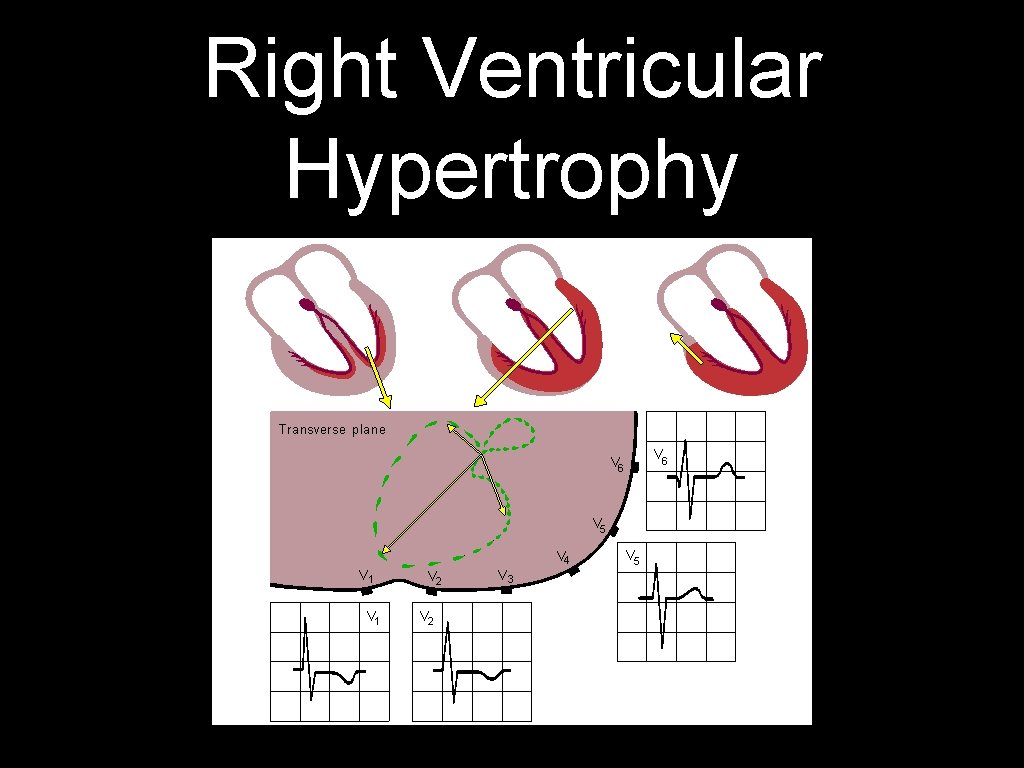 Right Ventricular Hypertrophy 