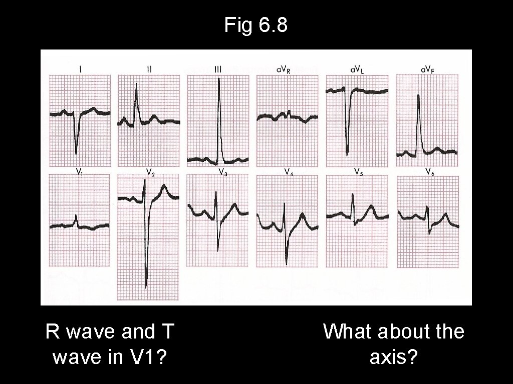 Fig 6. 8 R wave and T wave in V 1? What about the