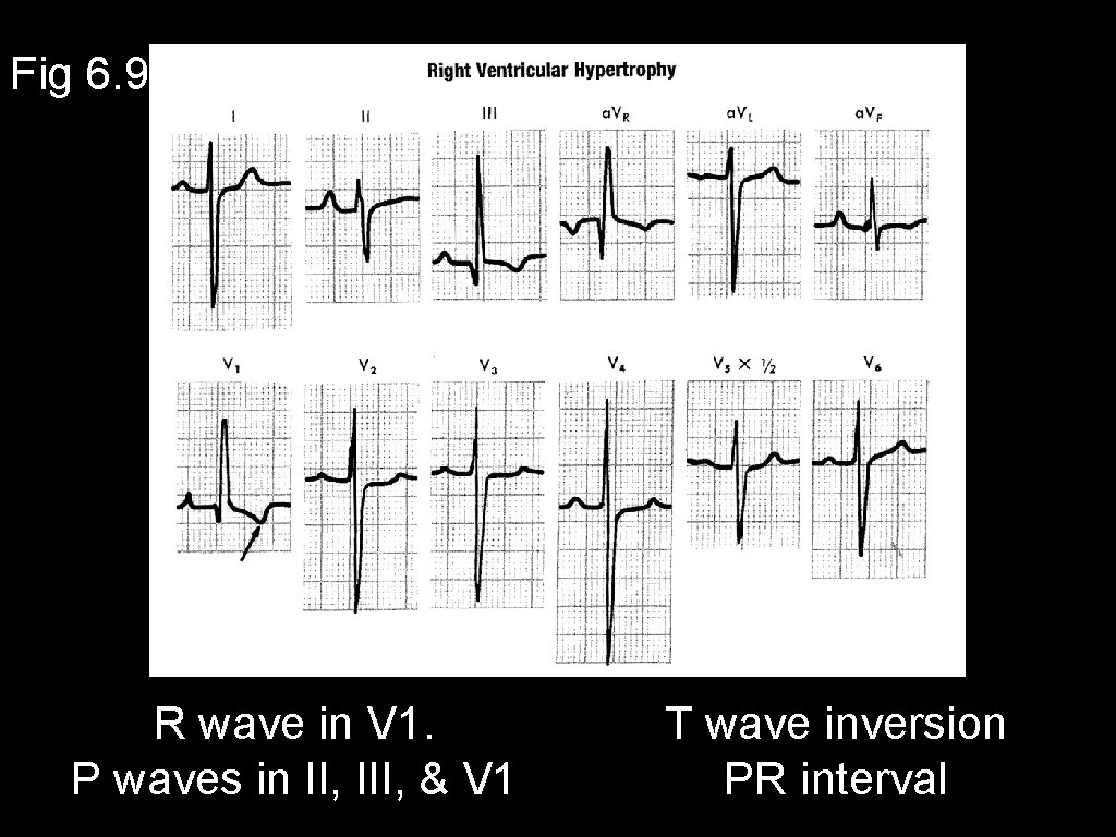 Fig 6. 9 R wave in V 1. P waves in II, III, &