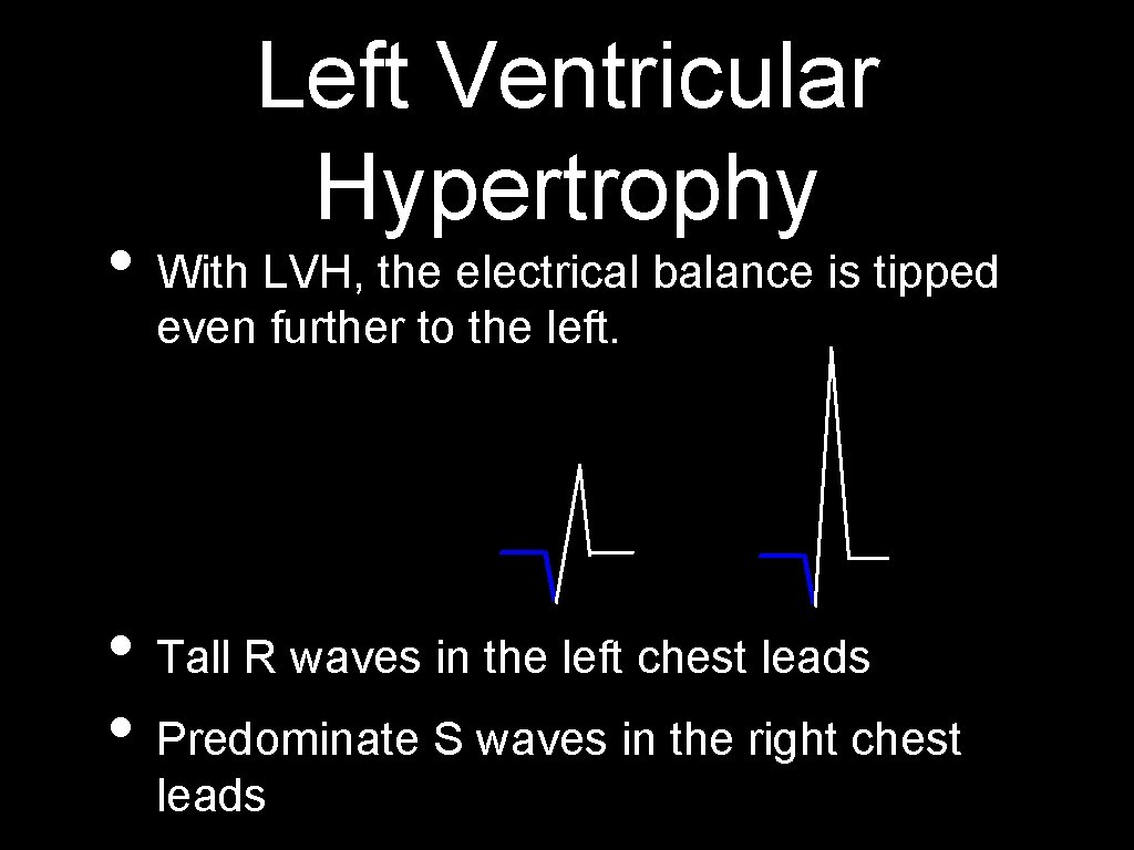 Left Ventricular Hypertrophy • With LVH, the electrical balance is tipped even further to