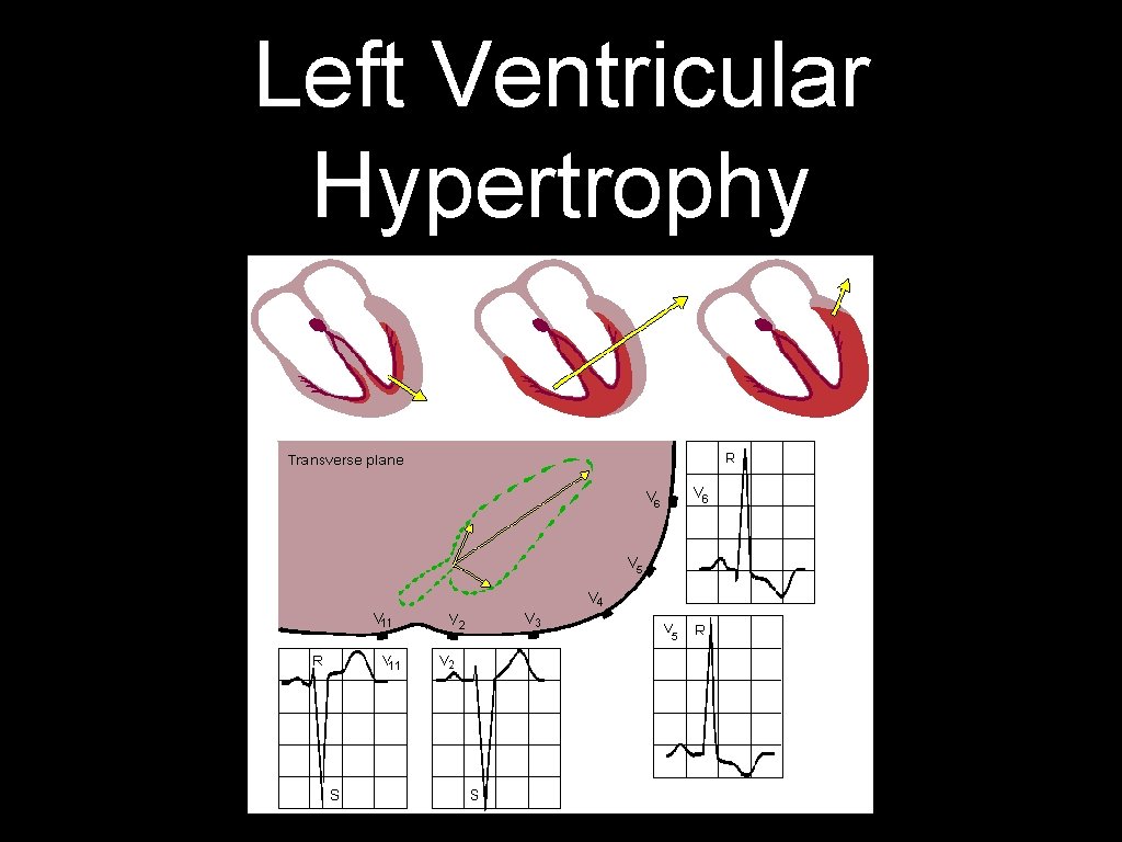 Left Ventricular Hypertrophy 