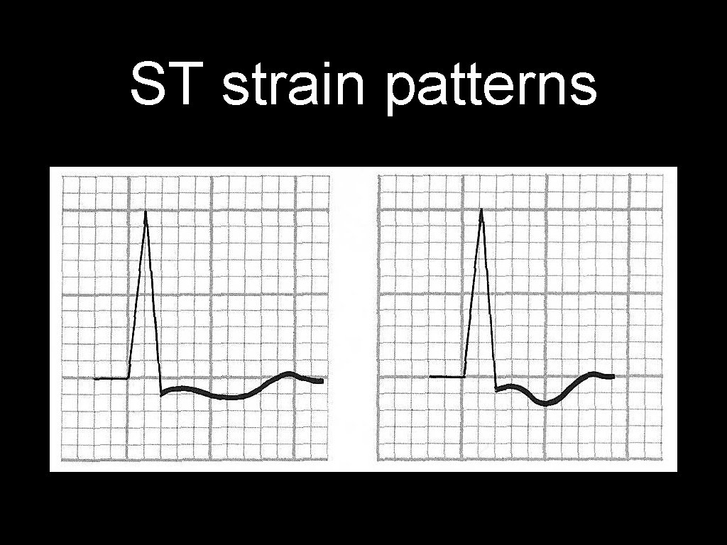 ST strain patterns 