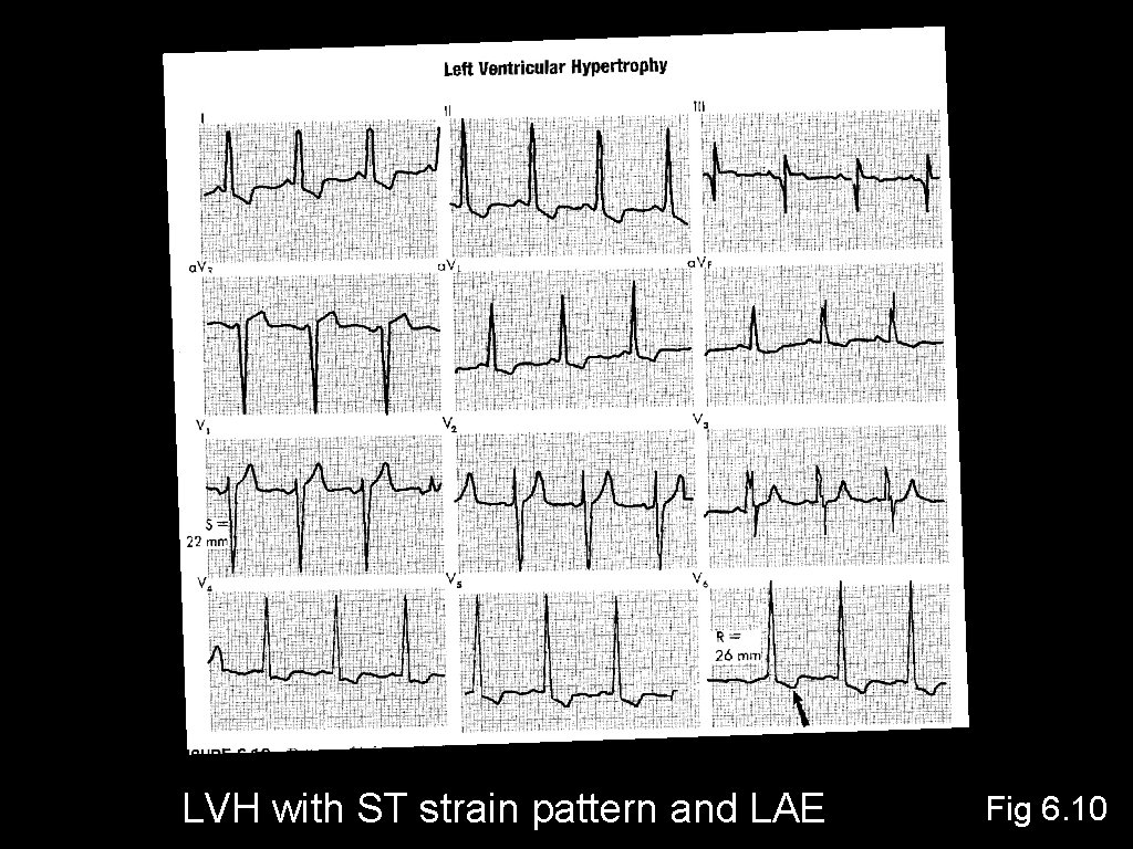 LVH with ST strain pattern and LAE Fig 6. 10 