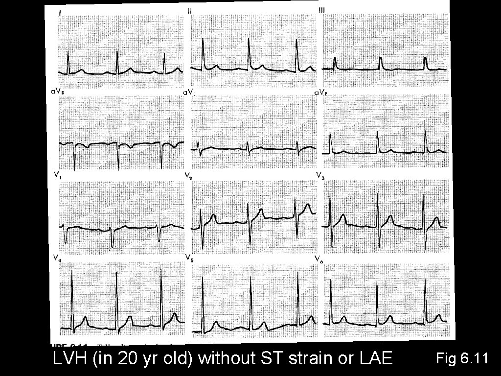 LVH (in 20 yr old) without ST strain or LAE Fig 6. 11 