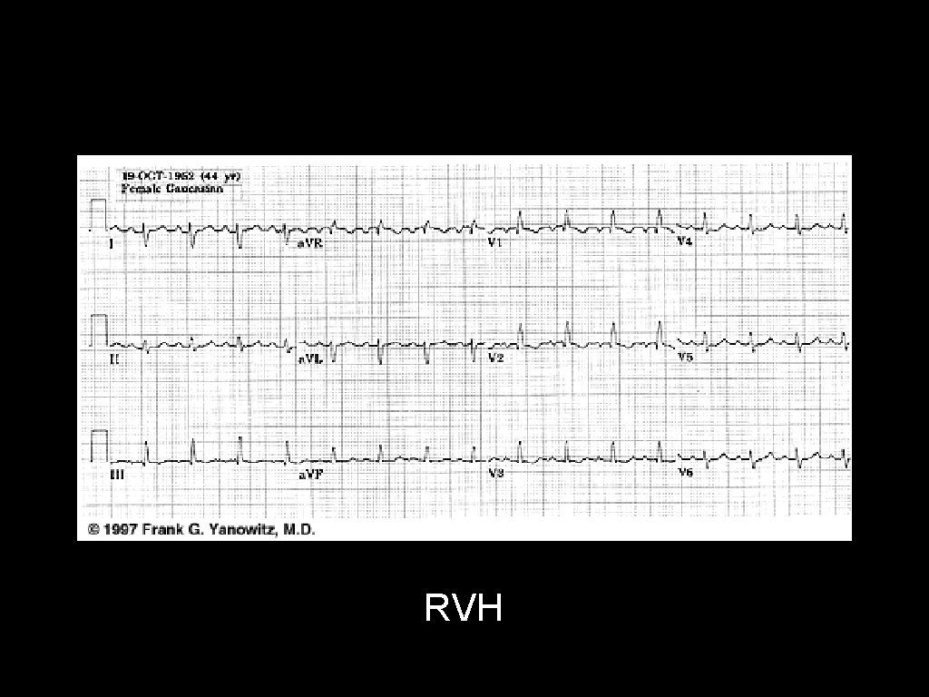 RVH 