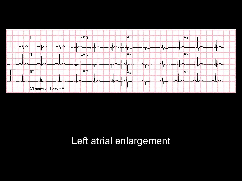 Left atrial enlargement 