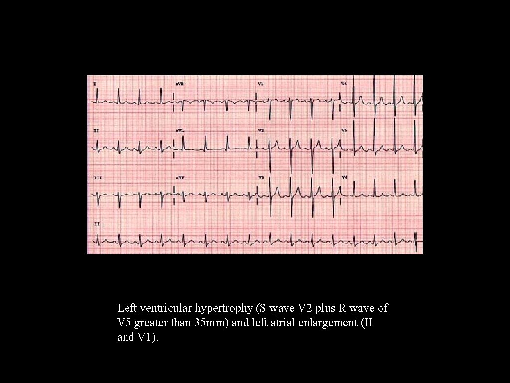 Left ventricular hypertrophy (S wave V 2 plus R wave of V 5 greater