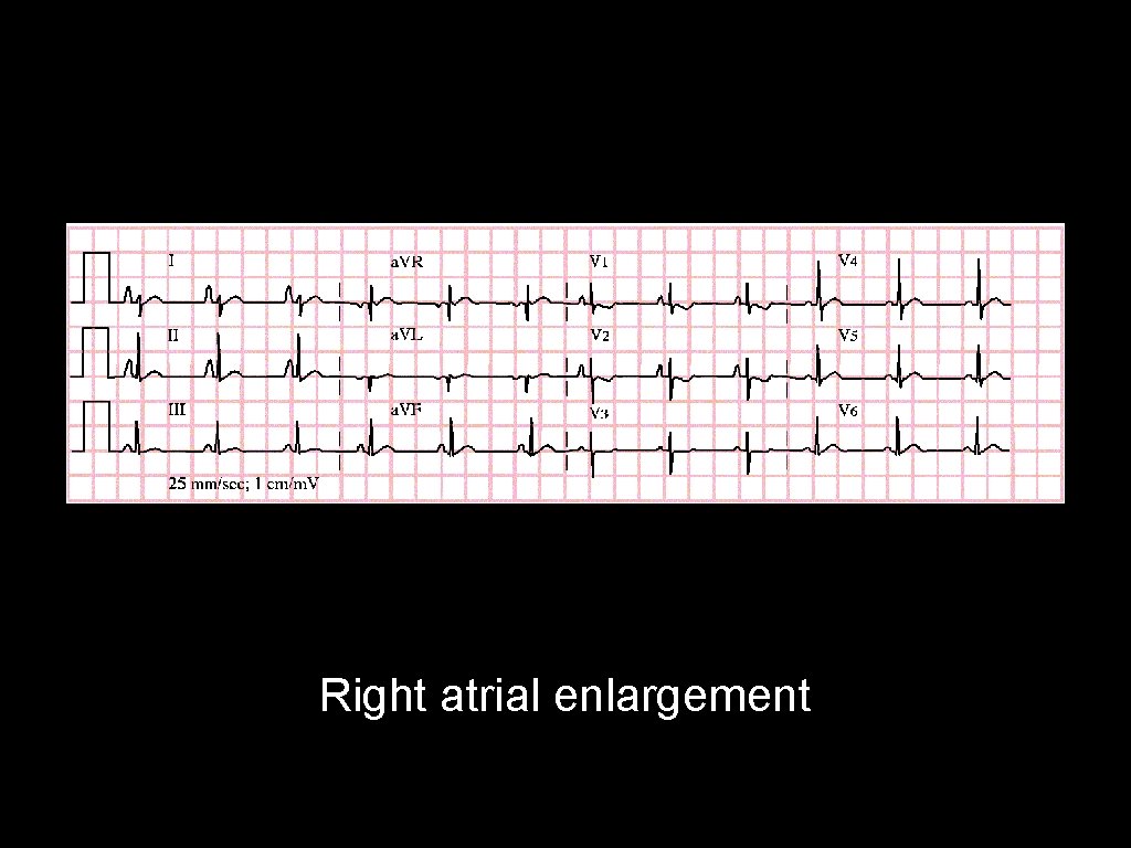 Right atrial enlargement 