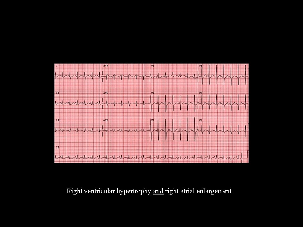 Right ventricular hypertrophy and right atrial enlargement. 