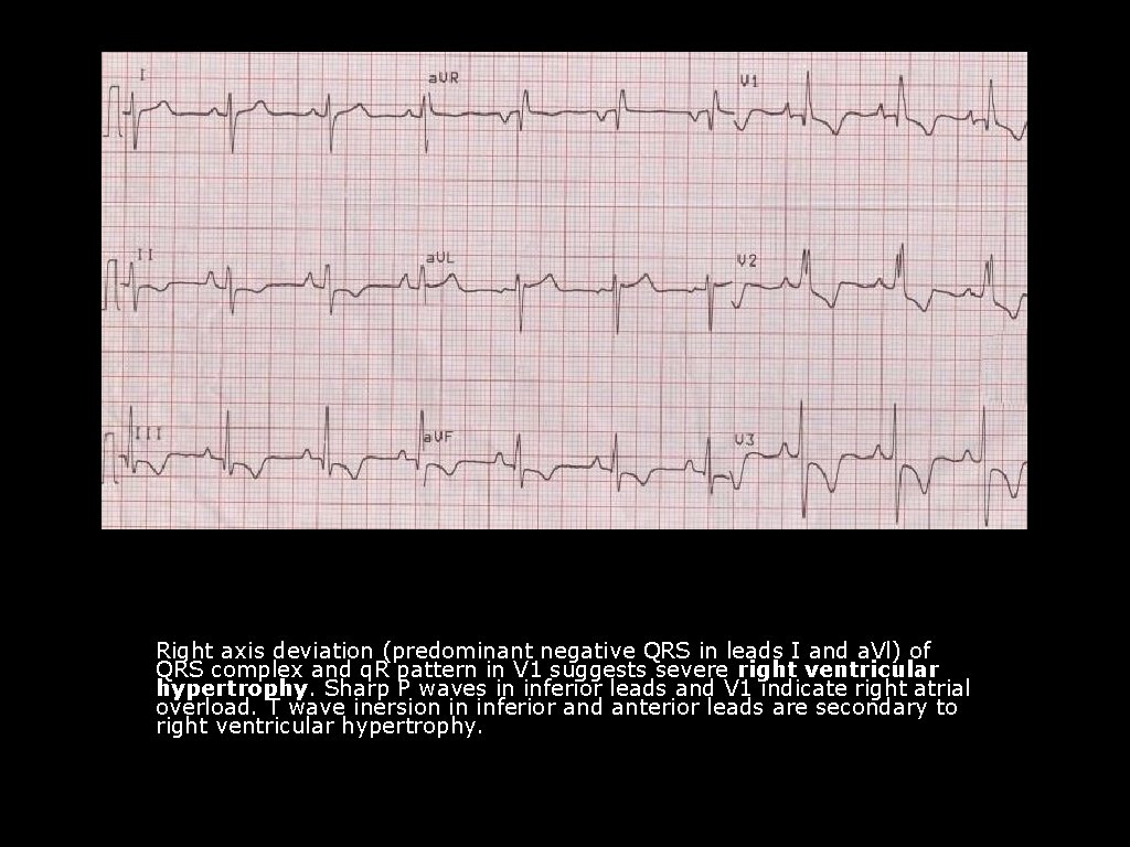 Right axis deviation (predominant negative QRS in leads I and a. Vl) of QRS